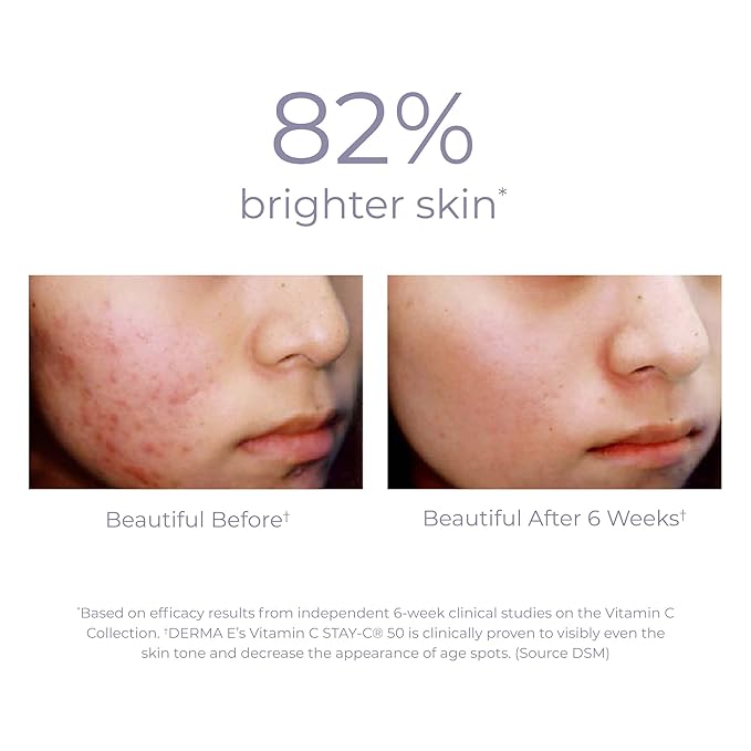 DERMA E Vitamin C Serum 10% Multi-Acid Radiance Liquid Peel – Exfoliating and Brightening Skin with Niacinamide Serum, Lactic Acid and Bromelain for Uneven Tone and Discoloration, 1 Fl Oz
