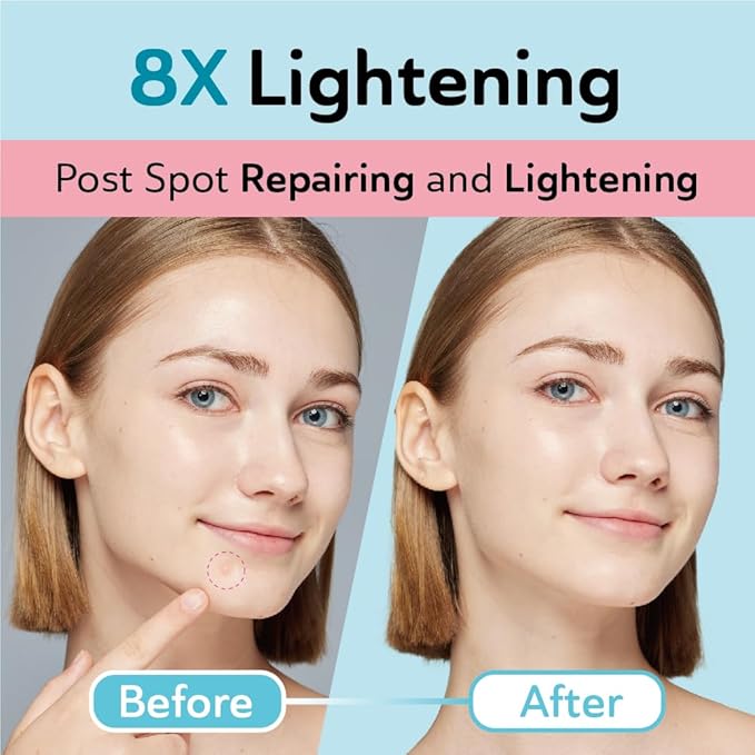 DERMA ANGEL Dark Spot Patches Blemish Patches with Hydrocolloid, TXA & CICA for Active Acne & Post-Inflammatory Dark Spots - Day and Night Use - UPGRADED (Post Acne - 96 Count - 1 Size)